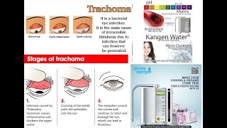 TRACHOMA EYES RELIEF WITH ENAGIC KANGEN WATER [upl. by Urbas266]