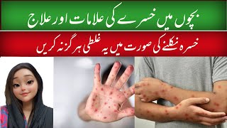 Khasra ki alamat  Measles Symptoms and treatment  khasra ka ilaj in urdu  AreejwithDr [upl. by Nnylrac]