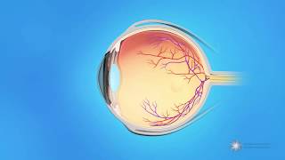 What causes a retinal tear or detachment [upl. by Simdars]