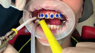 How Invisalign attachments are placed [upl. by Ahker]