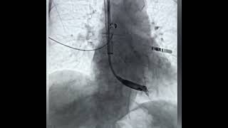 Aveir leadless pacemaker implant from RIJ neck access  Dr Sovari [upl. by Keeley507]