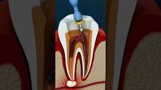 Root canal treatment tooth abscess shorts youtubeshorts viral rootcanal [upl. by Granny]