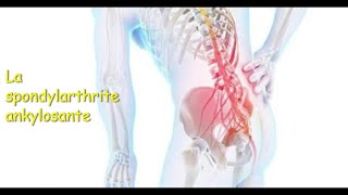 La spondylarthrite ankylosante et sa prise en charge kinésithérapique [upl. by Blau]