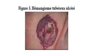 DERMATOLOGIE  cours 4  Angiome du nourrisson [upl. by Llennoj]