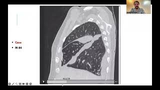 Interstitial pulmonary edema with fissural effusion Arabic version [upl. by Enomes]