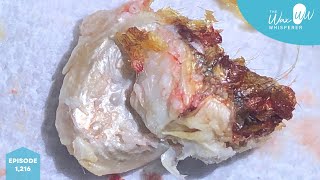 1216  Severe Grade III Keratosis Obturans Removal using Ear Hook [upl. by Deryl669]