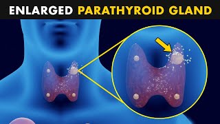 Hyperparathyroidism  Symptoms Causes And Treatment [upl. by Leynad183]