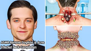 ASMR Deeply Cleansing Neck Infected with Acne and Dogticks [upl. by Schaper]