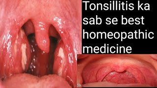 tonsillitis homoeopathic medicinetonsil homeopathy treattonsil homeopathy treatmenttonsil homeopathy [upl. by Sigler549]