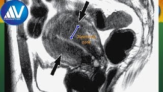 Adenomyosis part 2 [upl. by Lianna]