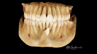 Surgical Extraction of an Impacted Mandibular Canine [upl. by Gassman]