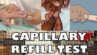 CAPILLARY REFILL TEST  FAST amp SIMPLE  Ohio University  Human Anatomy amp Physiology [upl. by Neddy887]