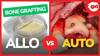 Allo vs Autograft for Dental Implants [upl. by Sined]