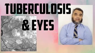 TUBERCULOSIS AND EYES Tuberculosis EyeinfectionRifampicinisoniazidethambutol [upl. by Dihsar]