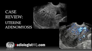 Case Review Ultrasound of Uterine Adenomyosis [upl. by Nugent484]