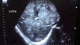 Ultrasonography of hepatic mass [upl. by Florella986]