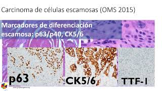 Clasificacion patologica de cáncer de pulmón de no células pequeñas Dr Hugo Castro Grupo Angeles [upl. by Bettina]