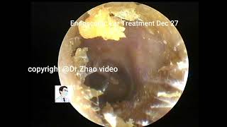 Cholesteatoma reexamination [upl. by Akel]