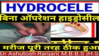 Hydrocele ka ilaj बिना operation hydrocele का मरीज पूरी तरह ठीक urology [upl. by Sheridan]