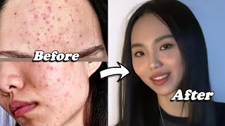 5 tips for Clear Skin How I got rid of Acne  Breakouts Remedy at home skin care routine x AMRIO [upl. by Lecram901]