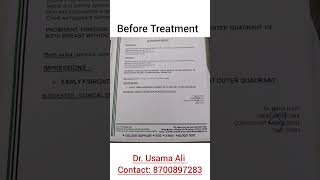 FIBROADENOMA treated with Homeopathy homeopathy fibroadenoma delhi6 viralvideo viralshorts [upl. by Annaik]