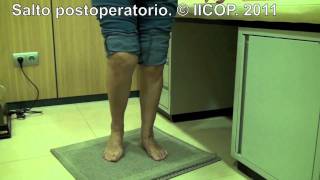 SECUELAS DE CIRUGIA PERCUTANEA DE HALLUX VALGUS mov [upl. by Brigitte]