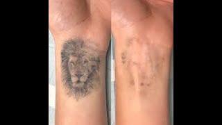 How To Remove Permanent Tattoo Naturally [upl. by Naegem]