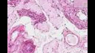 Histopathology Testis Atrophy [upl. by Ehsrop791]