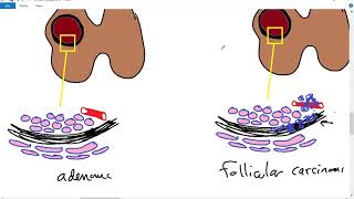 Systemic pathology 30  Endocrine 3  thyroid tumors  DRSAMEH GHAZY [upl. by Ennayehc]