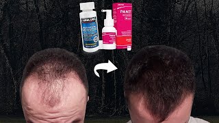 O MINOXIDIL PODE ENGROSSAR OS CABELOS QUE ESTÃO FINOS [upl. by Notfilc]