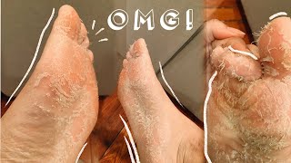 QUARANTINE SELF CARE  Foot Peel Mask in Self Isolation DID IT WORK [upl. by Laius423]