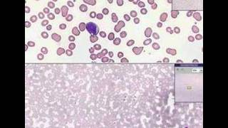 Histopathology Blood Acute leukemia [upl. by Dorothi]