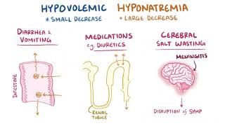 Hiponatremia [upl. by Silvestro759]