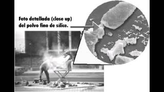 Pneumoconioses  Anthracosis Silicosis amp Asbestosis [upl. by Aicened]