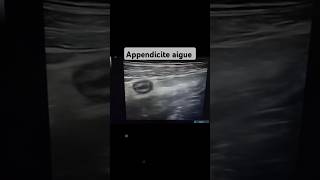 Échographie pelvienne Appendicite aigue non compliqué flowers docteur échographie medical [upl. by Vadim]