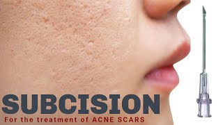 Subcision for Acne Scars  Advanced Dermatology amp Laser Institute of Seattle [upl. by Lipski]