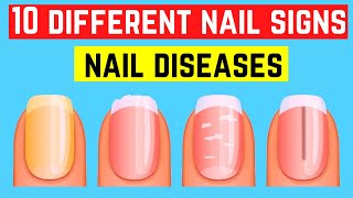 10 Different Nail Signs And Their Meanings  Nail Diseases ا ردو  हिंदी [upl. by Sadirah]