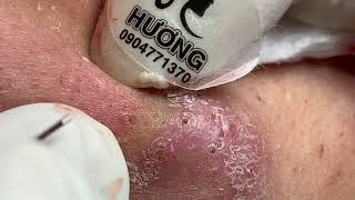 Make your Acne Treatment Huong Da Nang  479 acne 2022 [upl. by Divadnhoj468]