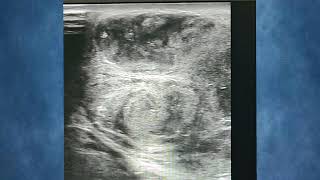 Testicular Abscess Complicated EpididymoOrchitis infection medical health ultrasound trending [upl. by Merwin]