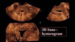 The Endometrium ultrasound [upl. by Peder]