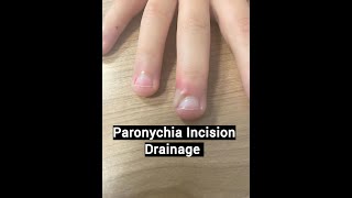 Paronychia Treatment [upl. by Eirret]