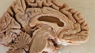 Third Ventricle  neuroanatomy  boundaries  recesses [upl. by Bonney646]