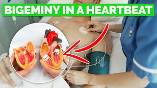 What is BIGEMINY Causes amp Preventions  Cardiac Arrhythmia Explained [upl. by Annayk]