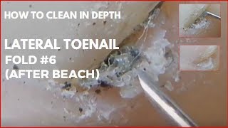 How to clean in depth lateral toenail fold 6 After beach [upl. by Brian]