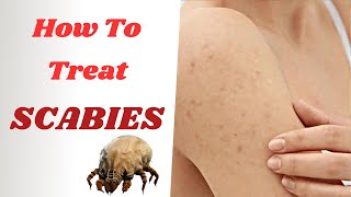 How To Treat Scabies Effectively  From PERMETHRIN Cream To IVERMECTIN Tablets [upl. by Mckenna]