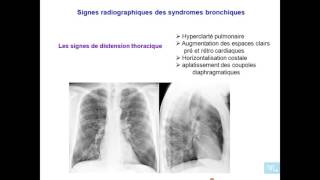 Les Grandes syndromes pulmonaires Partie 6 [upl. by Kellyn]