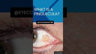 what is a pinguecula ¦eyecognizance [upl. by Berl]