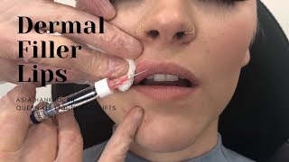 Dermal Filler Lips  1 Syringe RESTYLANE [upl. by Kenneth]