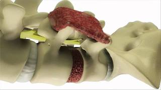 Transforaminal Lumbar Interbody Fusion TLIF Surgery  DePuy Back ampSpine [upl. by Azmuh]