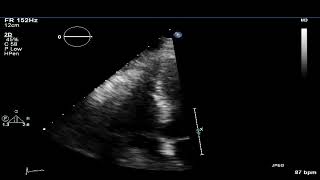 TTE  Renal Cell Cancer in the IVC and right heart [upl. by Lorne]